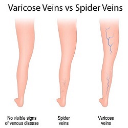 Veer Aim Care - Varicose Veins