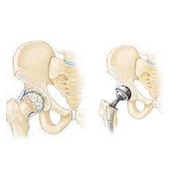 Veer Aim Care - Joint Replacement